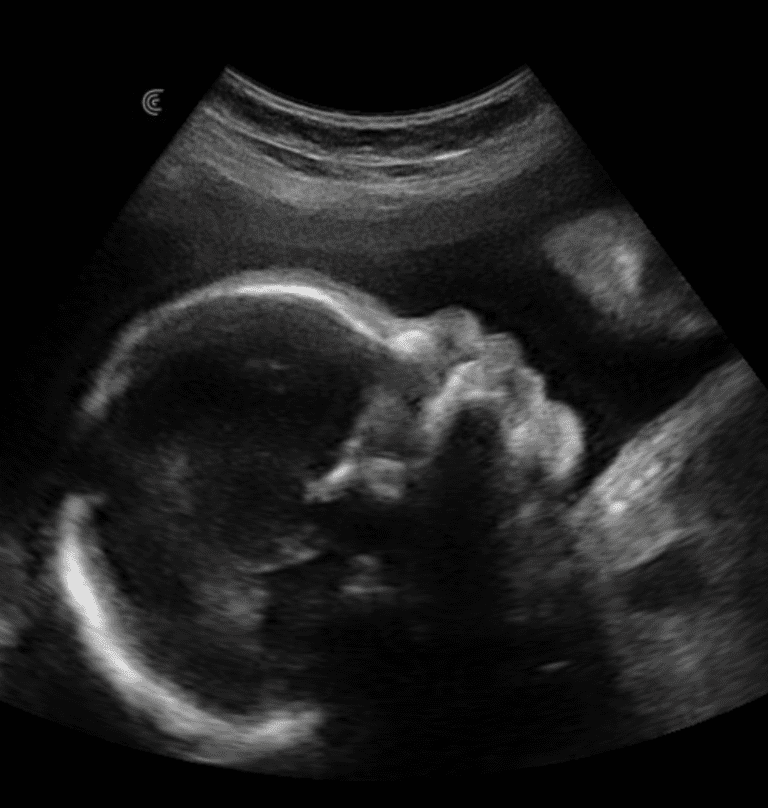 Read more about the article Tidlig scanning